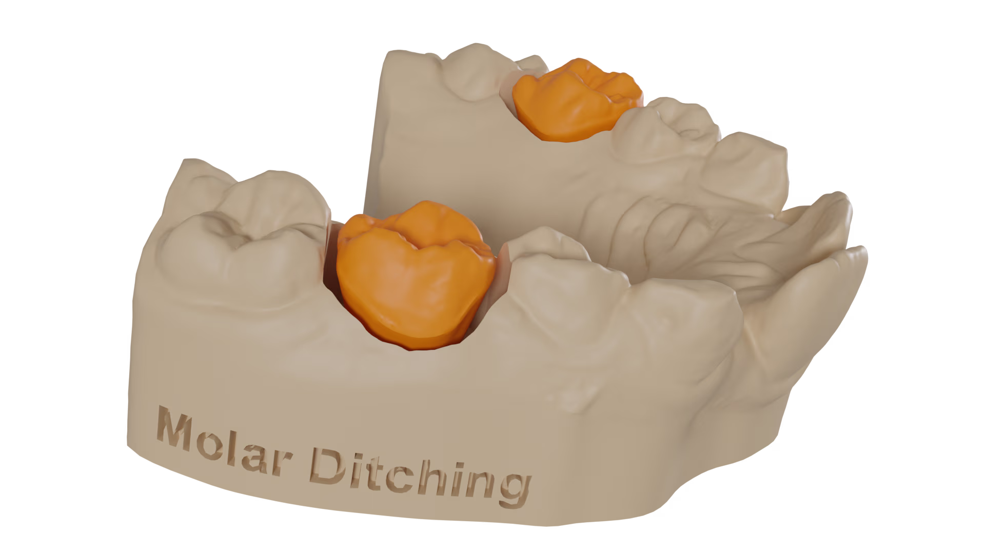 Molar ditching for use with molar bands and expanders
